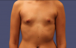 Breast Augmentation 16 Before